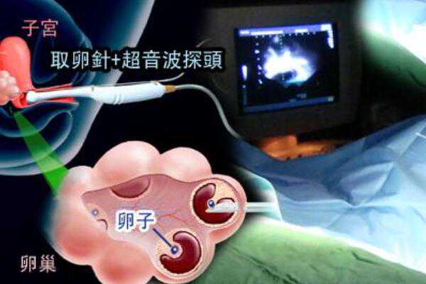 北京做供卵试管婴儿哪家医院好？,2023在北京申请供卵试管必备的条件